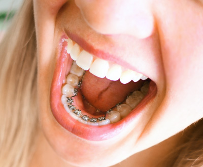 Lingual braces Stellar Orthodontics in Gilbert, AZ