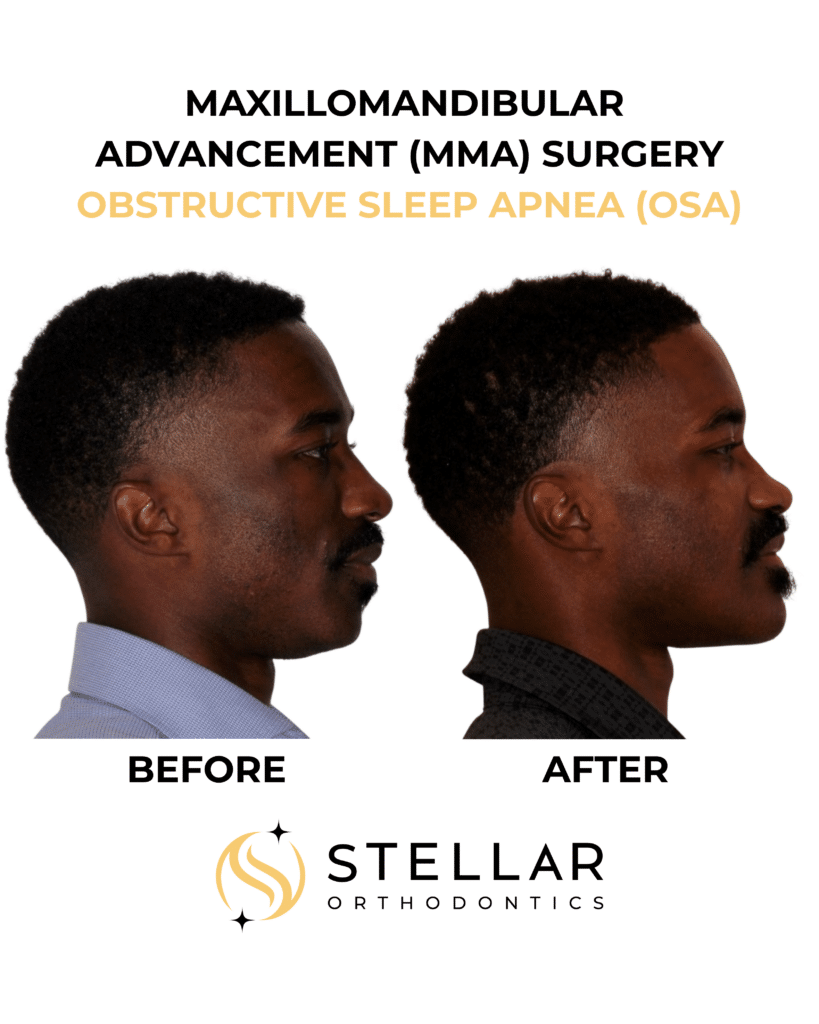 Before and after illustration of maxillomandibular advancement surgery for obstructive sleep apnea