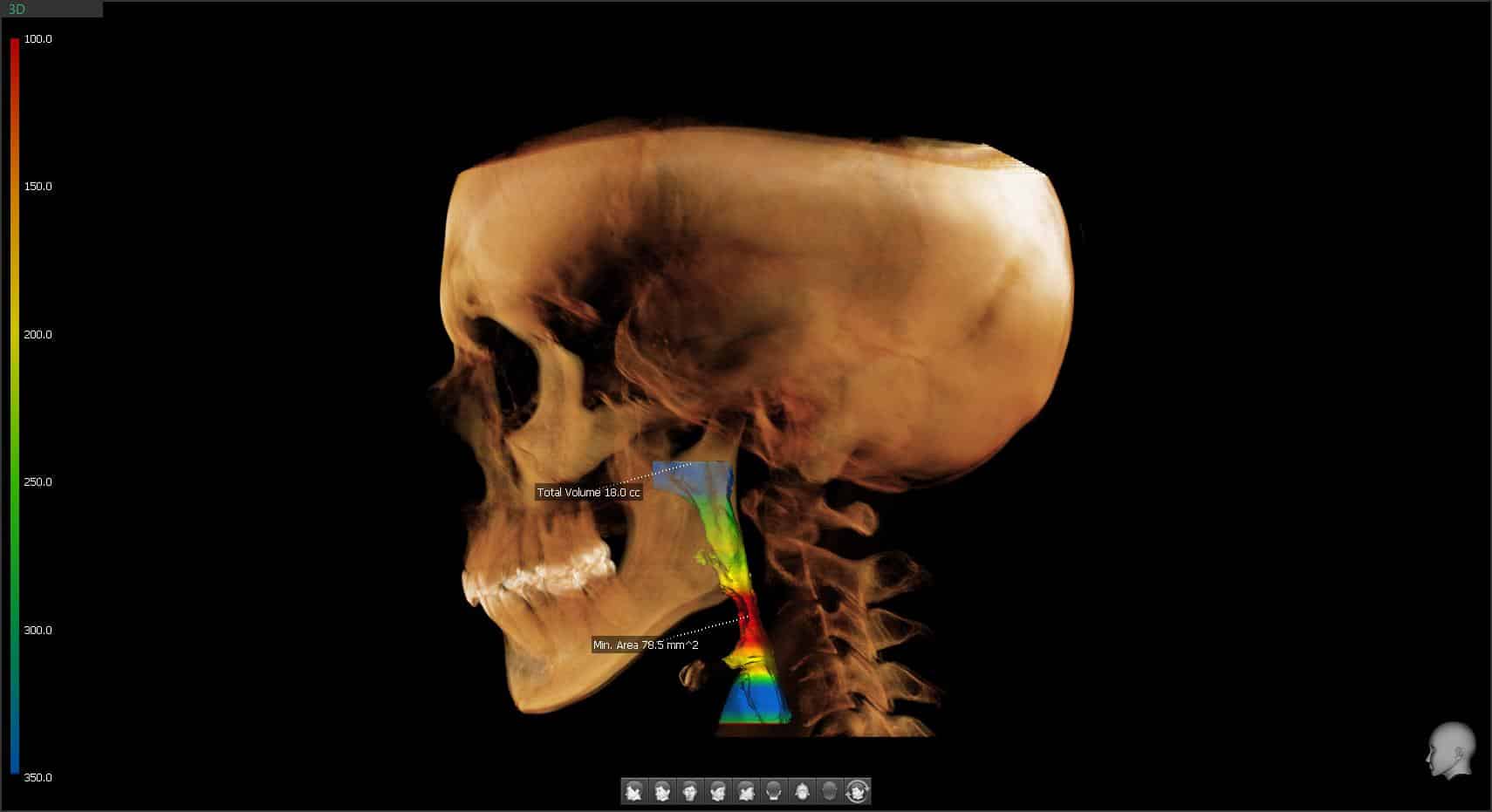 3D CBCT imaging scan showing a side view of the skull, jaw, teeth, and airway used for detailed orthodontic diagnosis and treatment planning.