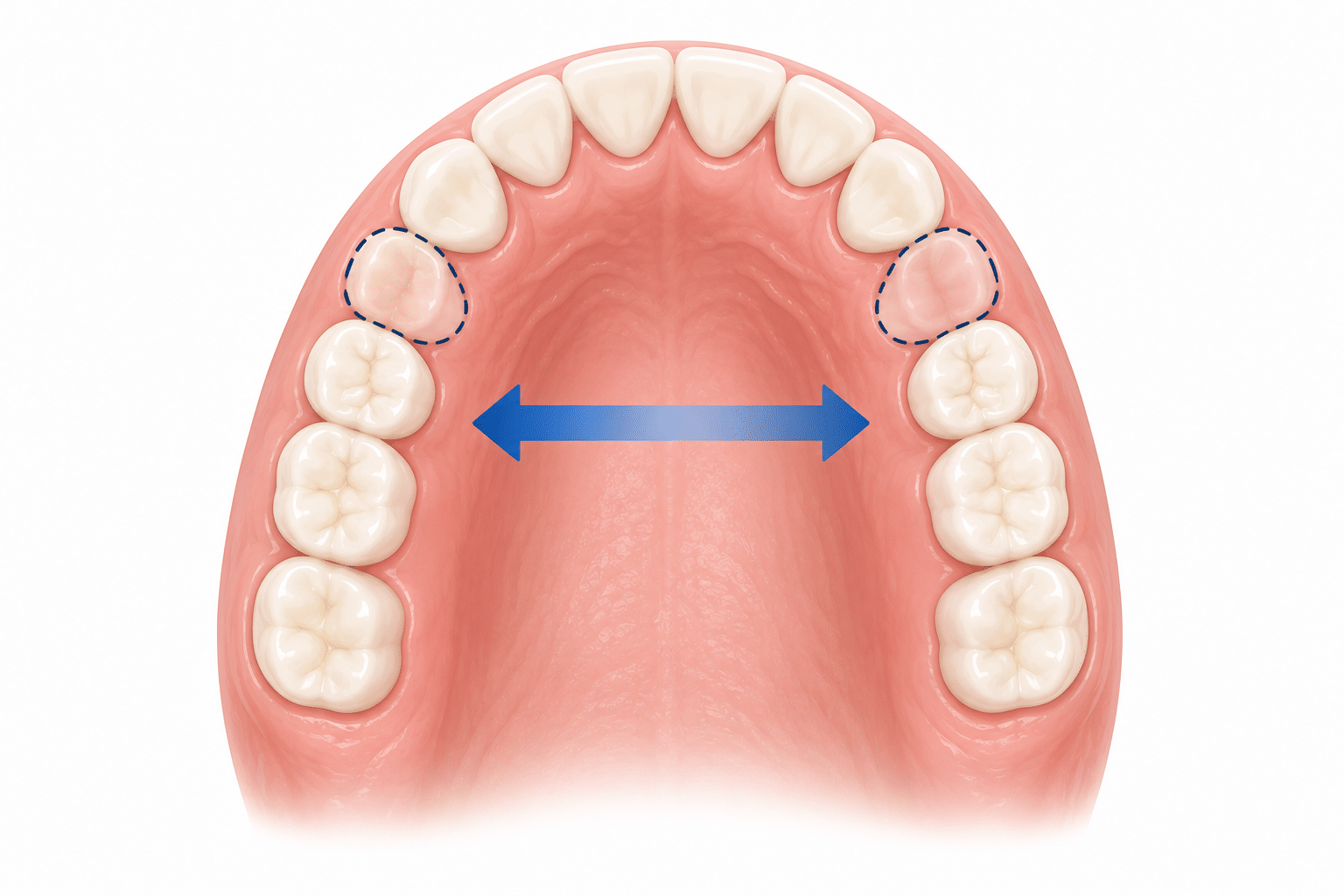Illustration showing space created for permanent teeth with orthodontic treatment