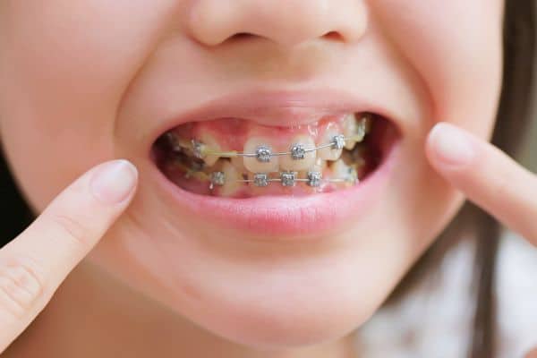 metal and ceramic braces